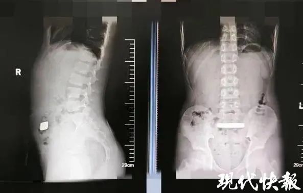 男孩误吞100克金条医生完整取出