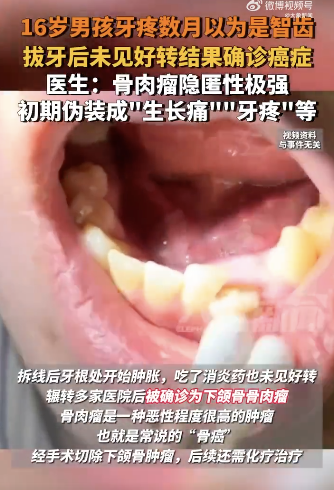 男孩牙痛确诊下颌骨骨肉瘤
