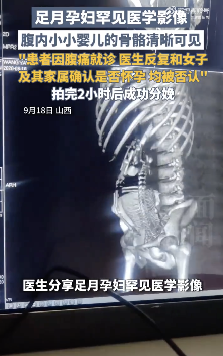 医生分享足月孕妇罕见的医学影像