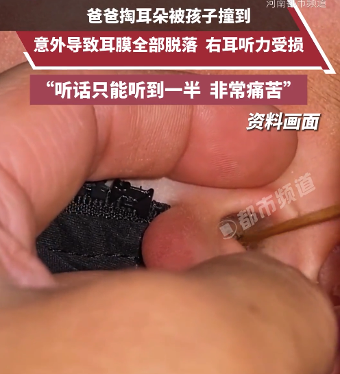 男子掏耳朵被2岁儿子撞致鼓膜脱落 医生：需观察半个月后再评估恢复情况