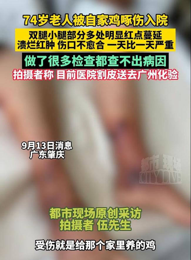 七旬老人被家鸡啄伤腿部溃烂