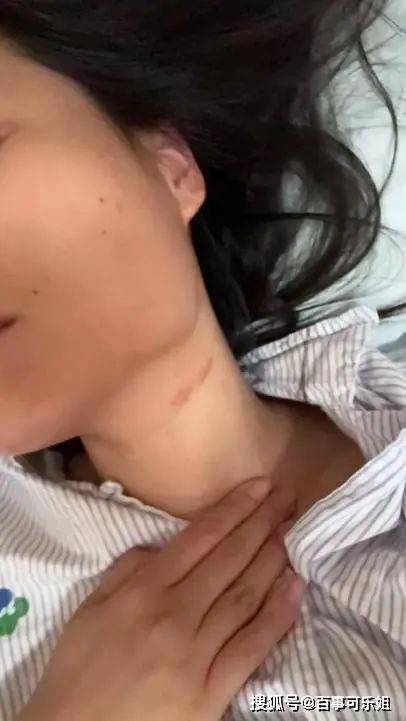 女子讲述被面试官殴打致骨折经过 求职噩梦揭露企业暴行