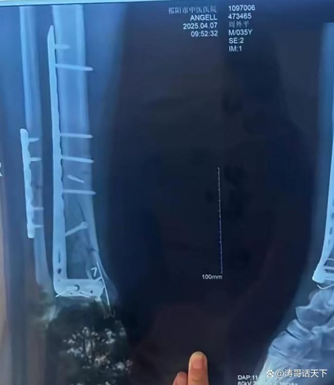 两病人手术体内被遗落钻头 医院隐瞒