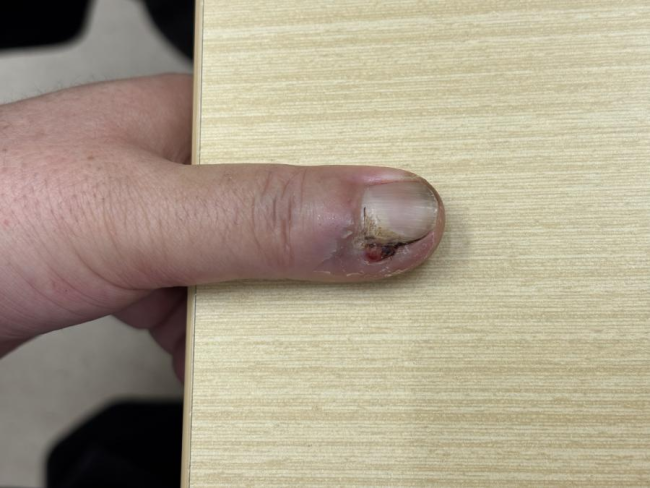 男子反复出现嵌甲确诊癌症