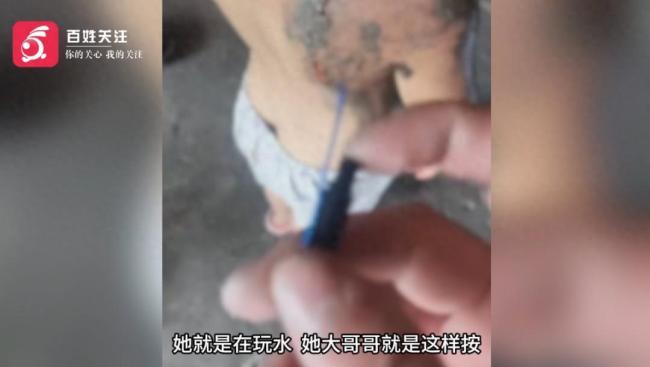 男孩用打火机零件电击洗澡妹妹致严重烧伤