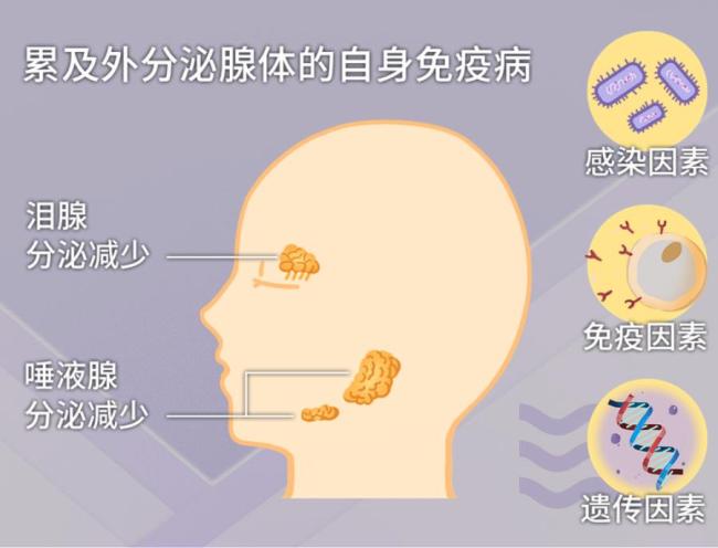 总是感觉口干舌燥？小心患上干燥综合征