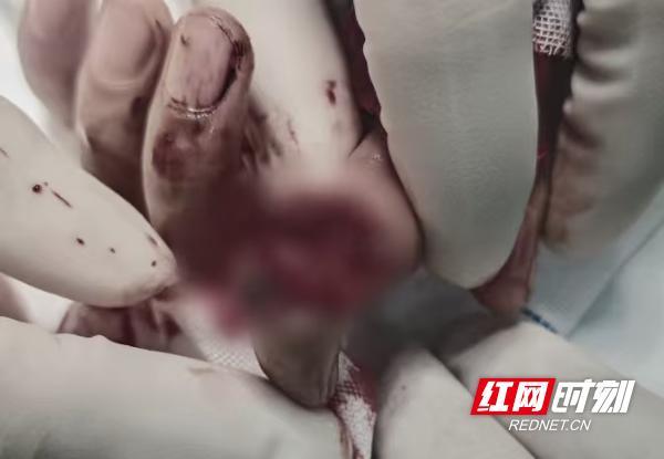 10岁男孩玩电动剪刀食指被切断