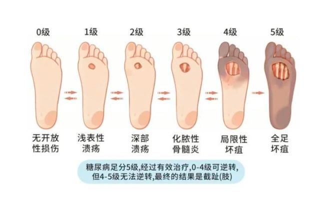 男子患糖尿病剪指甲不小心剪破拇趾,不到两年竟切除十根脚趾! 医生提醒