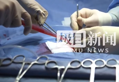 女子吃生菜卷烤肉体内取出20厘米蛔虫 专家紧急提醒:生菜卷烤肉暗藏风险