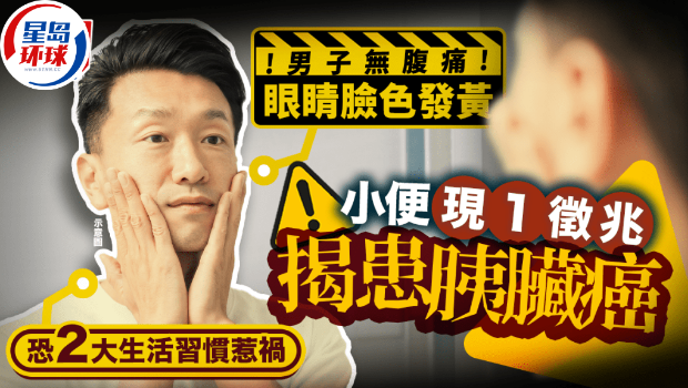 小便现1征兆揭患胰脏癌 小便现1征兆揭患胰脏癌