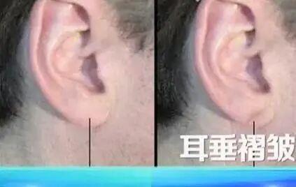 血管堵不堵 看脸和腿就知道？6个信号别忽视