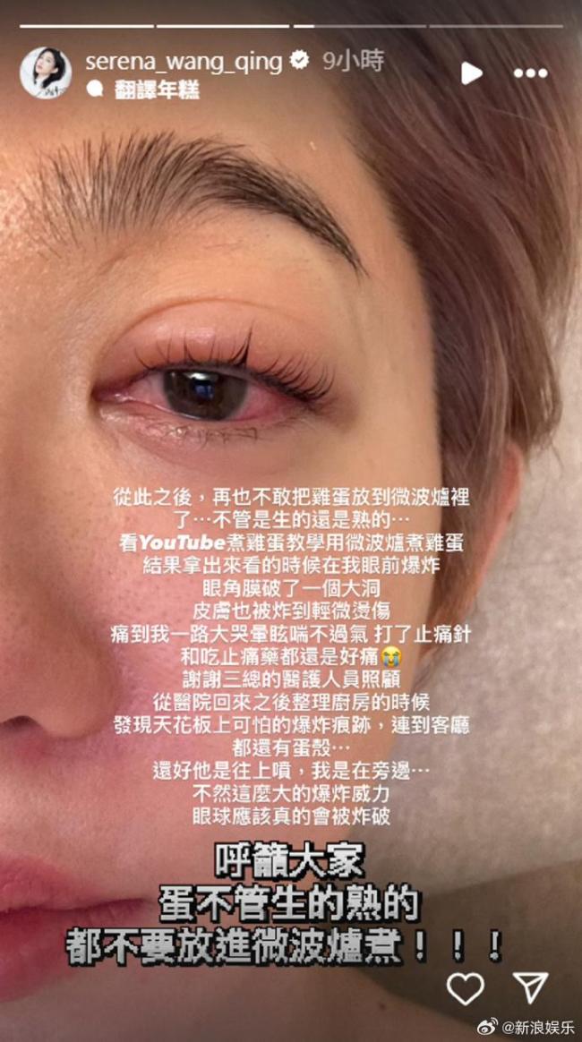 台湾女演员王晴微波炉煮蛋被炸伤