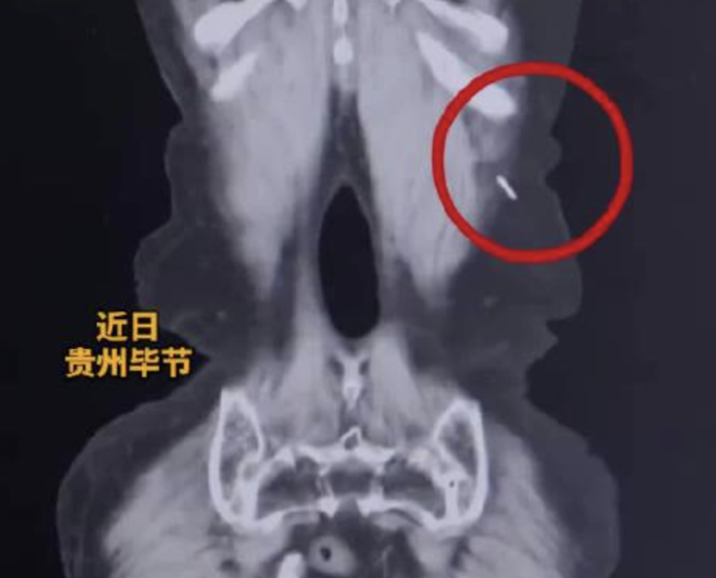 女子腹疼多年手术取出半截绣花针 医患纠纷真相揭晓
