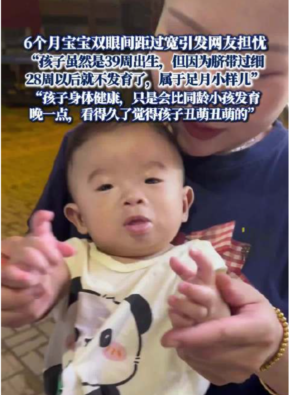 妈妈回应6个月宝宝眼距过宽引担忧