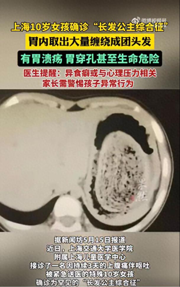 10岁女孩确诊长发公主综合征