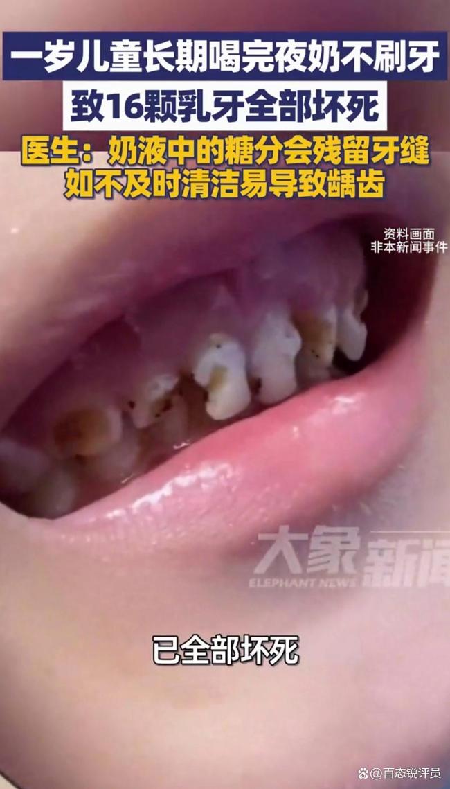 1岁儿童喝夜奶不刷牙致16颗牙坏死