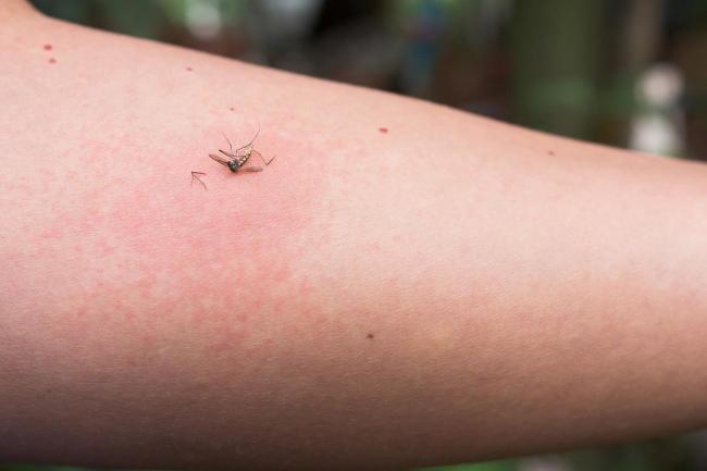 为啥蚊子总盯着你咬 六大关键因素揭秘