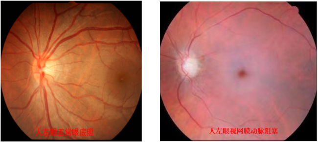 高三女生“眼中风”永久致盲 黄金90分钟及时自救