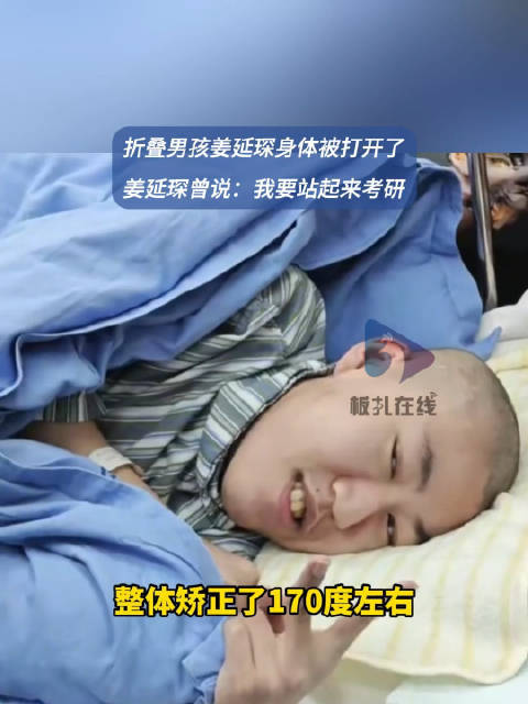 首例反向折叠人矫正手术完成！
