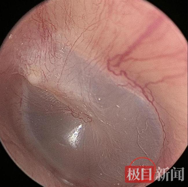 男子长期和猫同睡耳中长出猫螨虫