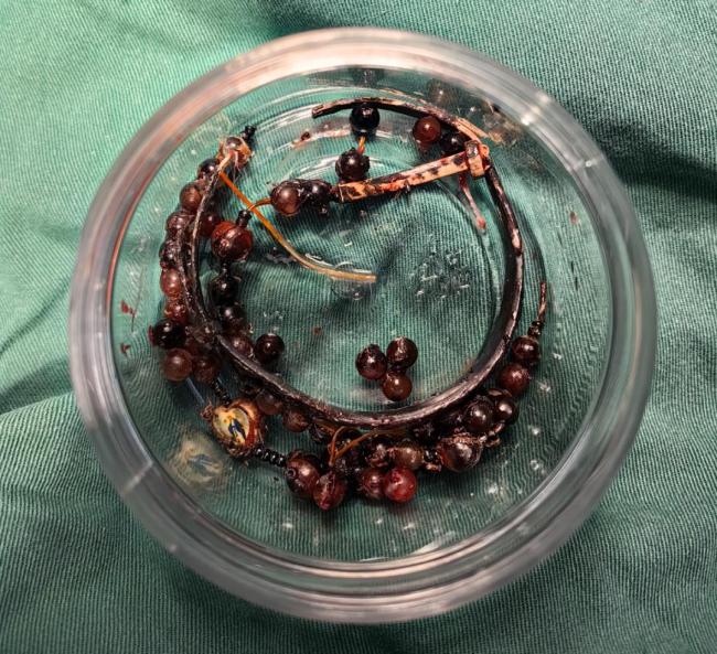 女子手镯10年未摘“长”进肉里