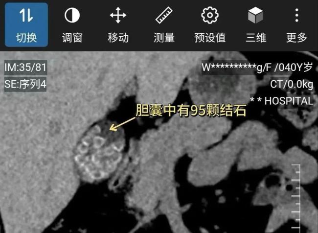 女子长期不吃早饭胆囊长满结石