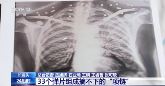 这条摘不下的“项链”成了他的光荣勋章