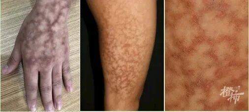 一觉睡醒长出“蟒蛇纹”、水疱！冬季警惕这类烫伤