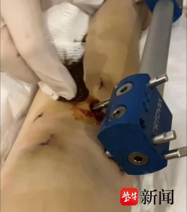 女子60万断骨增高感染护士仅涂碘伏 医托骗局曝光