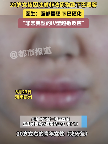 20岁女孩为变美注射玻尿酸毁容