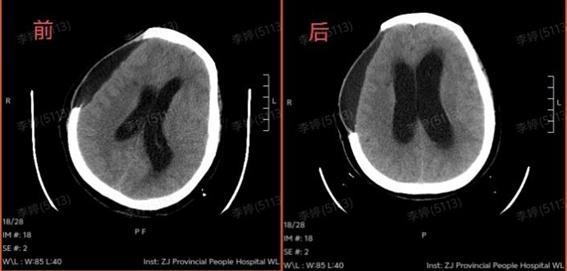 高温晒背2小时67岁阿姨开颅保命